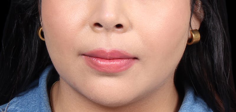 Buccal Fat Removal Before & After Gallery - Patient 423076 - Image 4