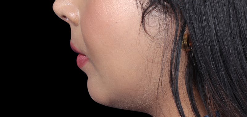 Buccal Fat Removal Before & After Gallery - Patient 423076 - Image 6