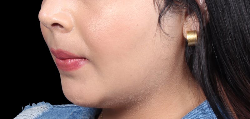 Buccal Fat Removal Before & After Gallery - Patient 423076 - Image 8