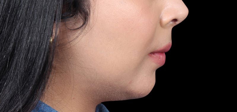 Buccal Fat Removal Before & After Gallery - Patient 423076 - Image 10
