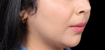 Buccal Fat Removal Before & After Gallery - Patient 423076 - Image 2