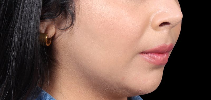 Buccal Fat Removal Before & After Gallery - Patient 423076 - Image 2