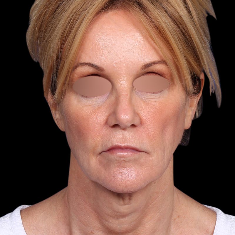 Facelift Before & After Gallery - Patient 113047 - Image 3