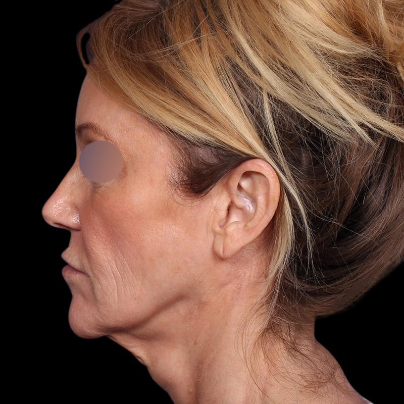 Facelift Before & After Gallery - Patient 113047 - Image 9