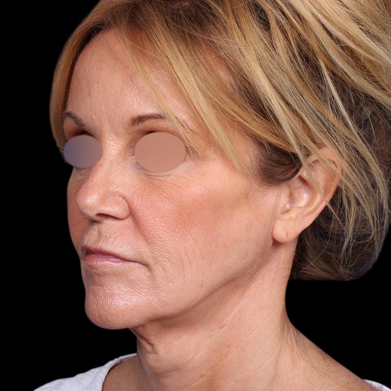 Facelift Before & After Gallery - Patient 113047 - Image 7