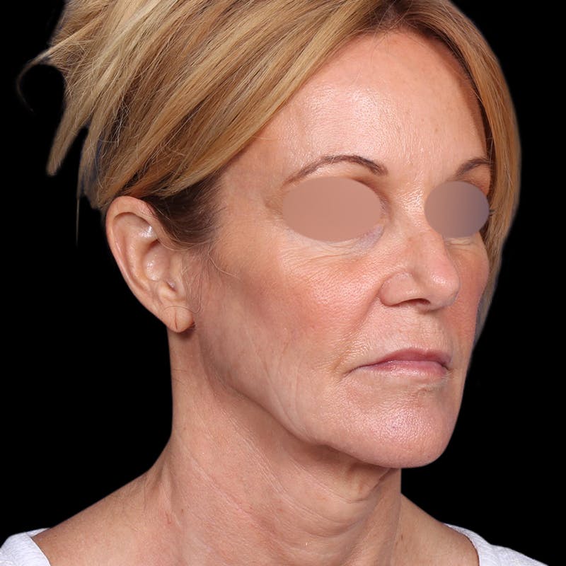 Facelift Before & After Gallery - Patient 113047 - Image 5