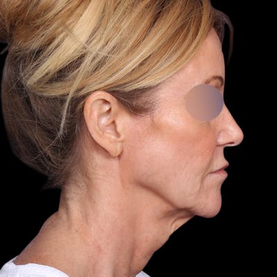 Facelift Before & After Gallery - Patient 113047 - Image 1