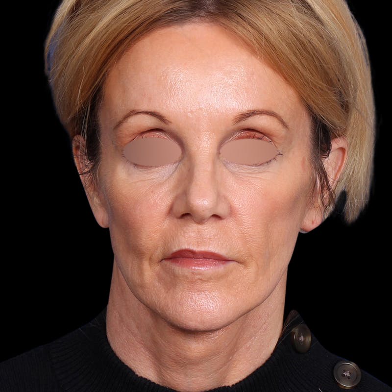 Facelift Before & After Gallery - Patient 113047 - Image 4