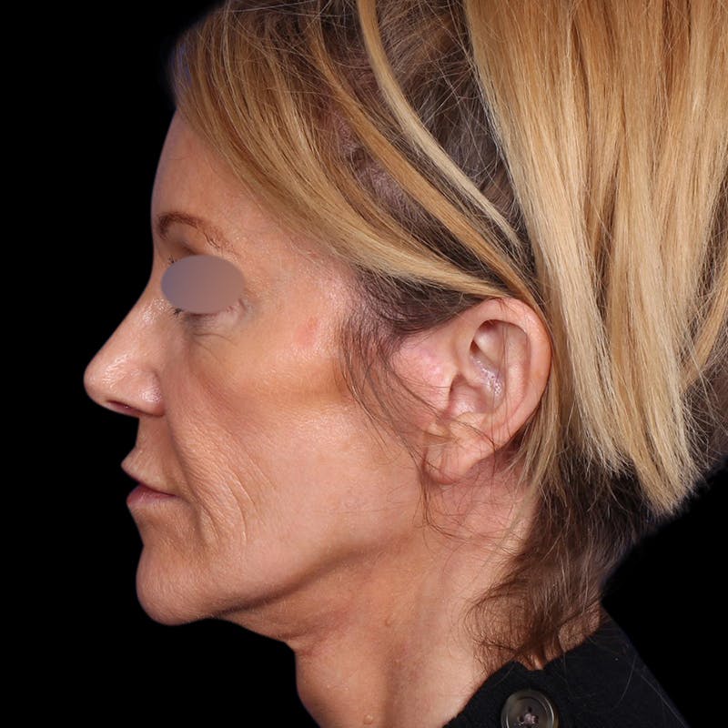 Facelift Before & After Gallery - Patient 113047 - Image 10