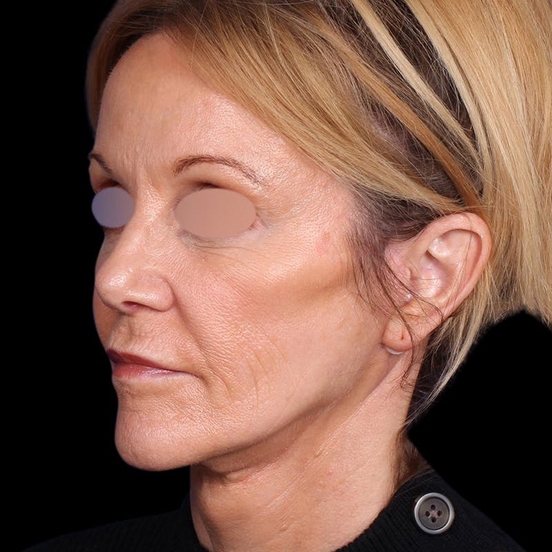 Facelift Before & After Gallery - Patient 113047 - Image 8