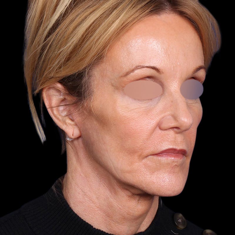 Facelift Before & After Gallery - Patient 113047 - Image 6
