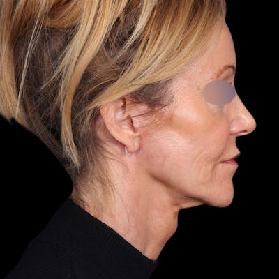 Facelift Before & After Gallery - Patient 113047 - Image 2