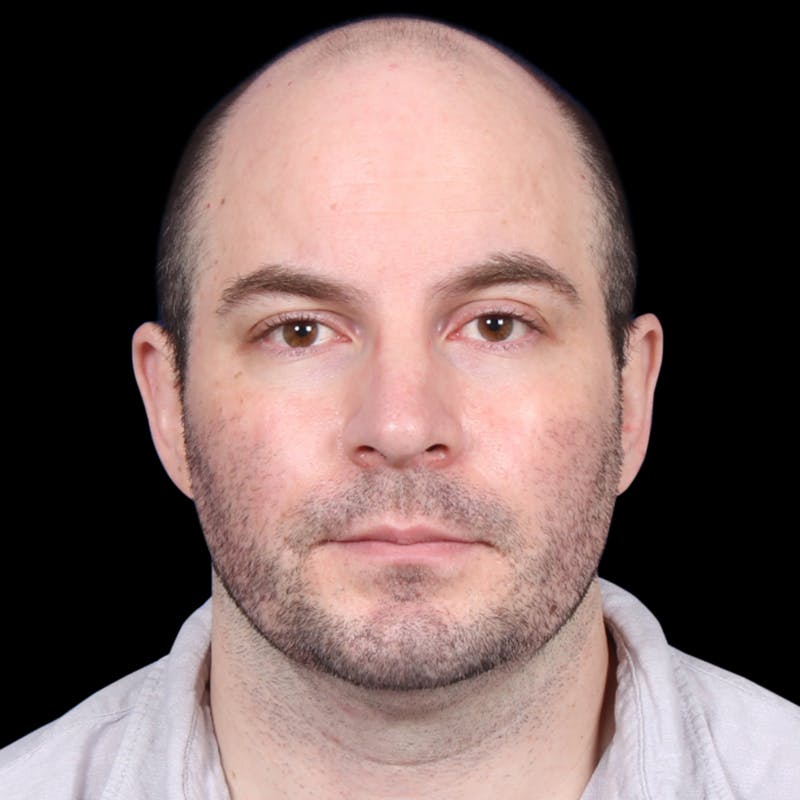 Facelift Before & After Gallery - Patient 173528 - Image 3