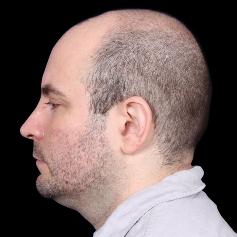 Facelift Before & After Gallery - Patient 173528 - Image 5
