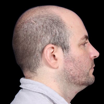 Facelift Before & After Gallery - Patient 173528 - Image 1