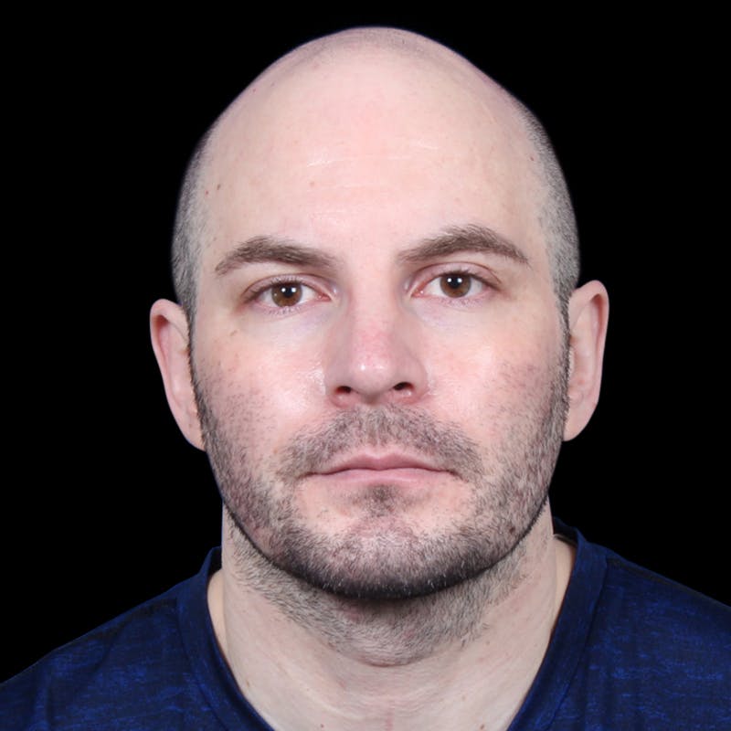 Facelift Before & After Gallery - Patient 173528 - Image 4