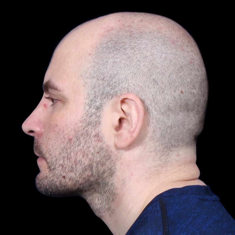 Facelift Before & After Gallery - Patient 173528 - Image 6