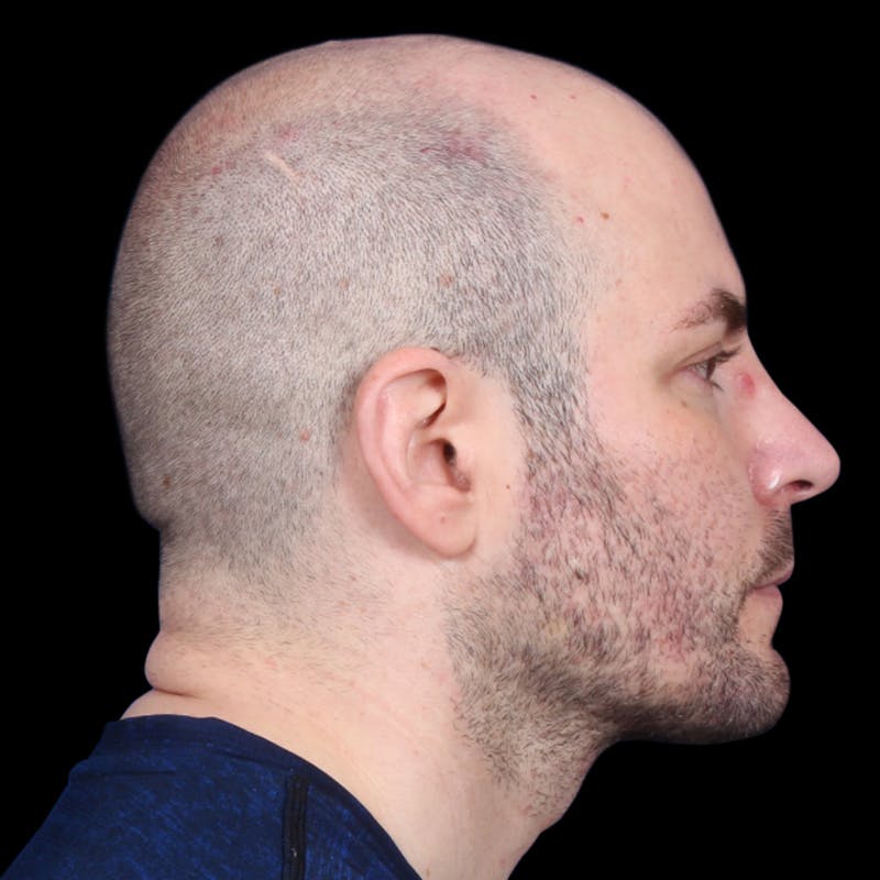 Facelift Before & After Gallery - Patient 173528 - Image 2