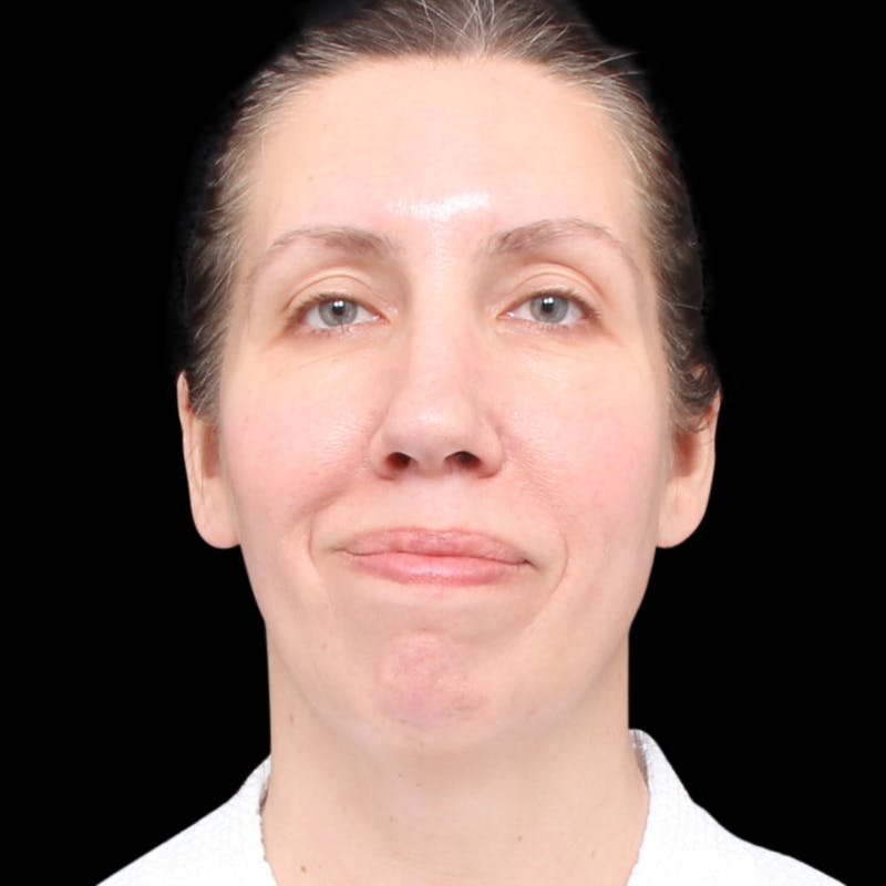 Facelift Before & After Gallery - Patient 111402 - Image 3
