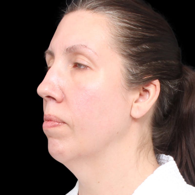 Facelift Before & After Gallery - Patient 111402 - Image 5