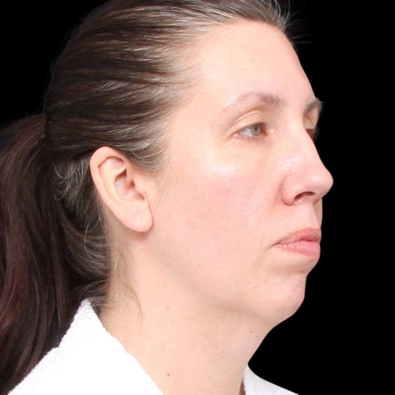 Facelift Before & After Gallery - Patient 111402 - Image 7