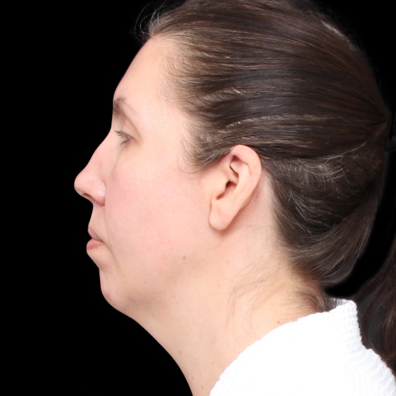 Facelift Before & After Gallery - Patient 111402 - Image 9