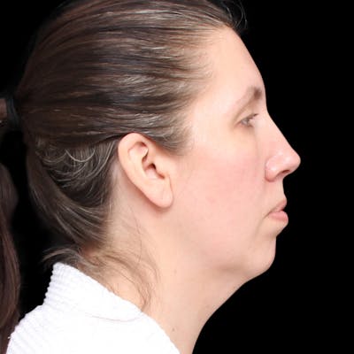 Facelift Before & After Gallery - Patient 111402 - Image 1