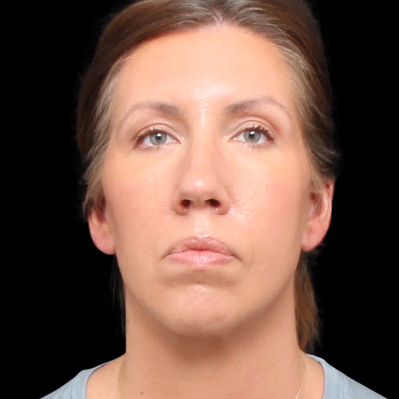 Facelift Before & After Gallery - Patient 111402 - Image 4