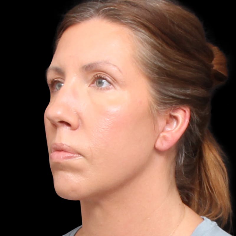 Facelift Before & After Gallery - Patient 111402 - Image 6