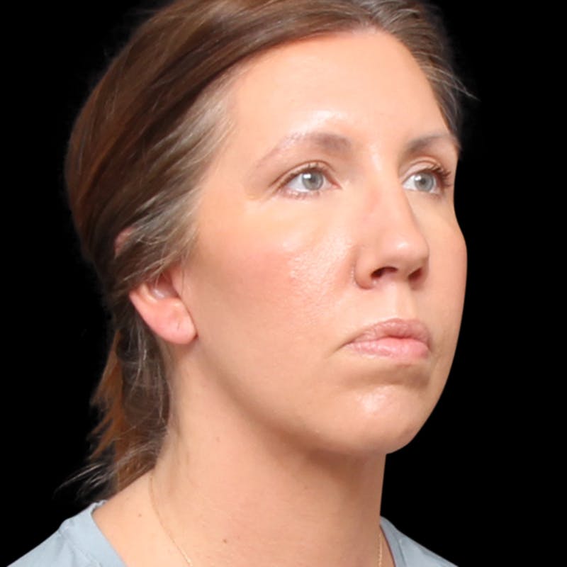 Facelift Before & After Gallery - Patient 111402 - Image 8