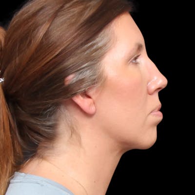 Facelift Before & After Gallery - Patient 111402 - Image 2
