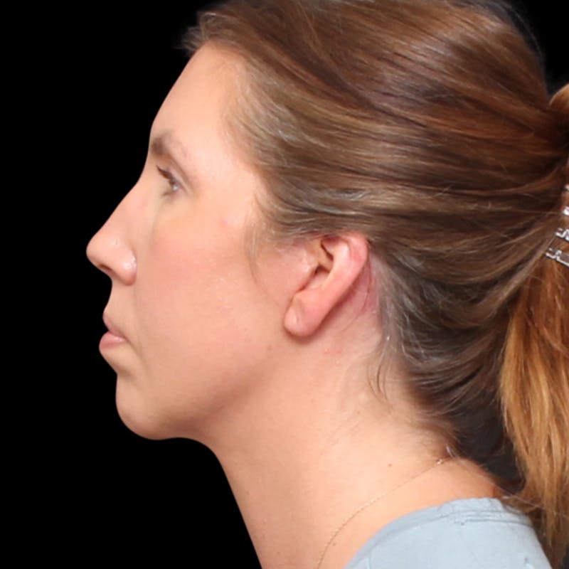 Facelift Before & After Gallery - Patient 111402 - Image 10