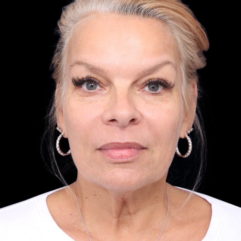 Facelift Before & After Gallery - Patient 337358 - Image 3