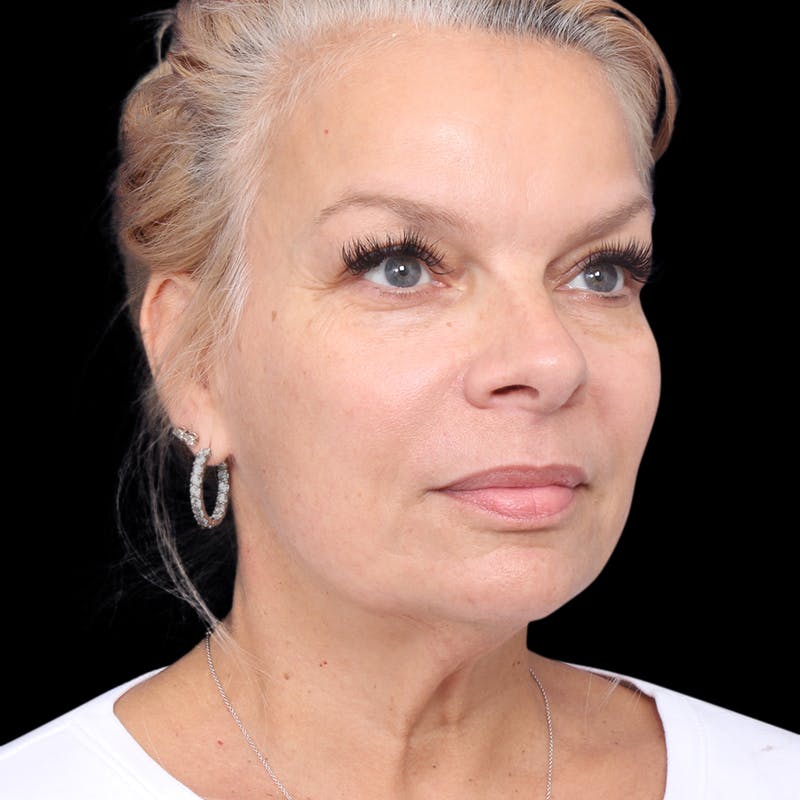 Facelift Before & After Gallery - Patient 337358 - Image 5