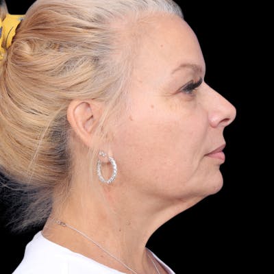 Facelift Before & After Gallery - Patient 337358 - Image 1