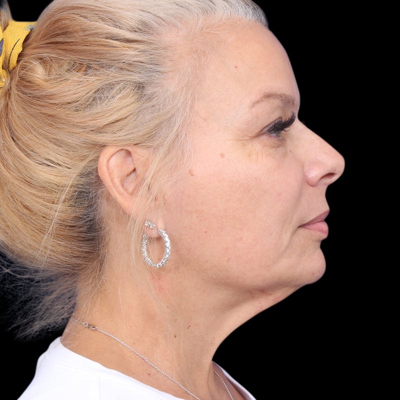 Facelift Before & After Gallery - Patient 337358 - Image 1