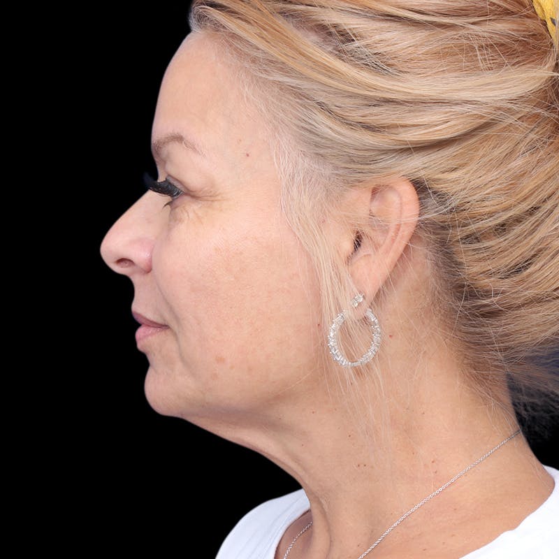 Facelift Before & After Gallery - Patient 337358 - Image 9
