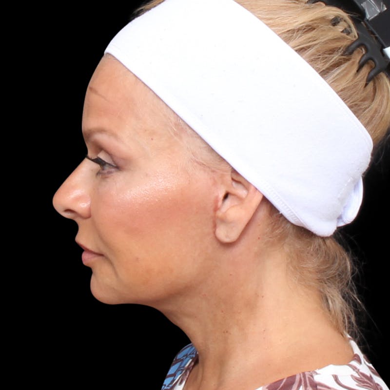 Facelift Before & After Gallery - Patient 337358 - Image 10