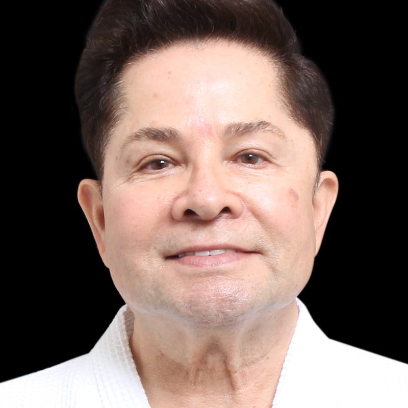 Facelift Before & After Gallery - Patient 524716 - Image 3