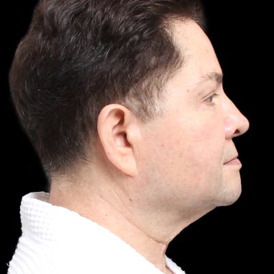 Facelift Before & After Gallery - Patient 524716 - Image 1
