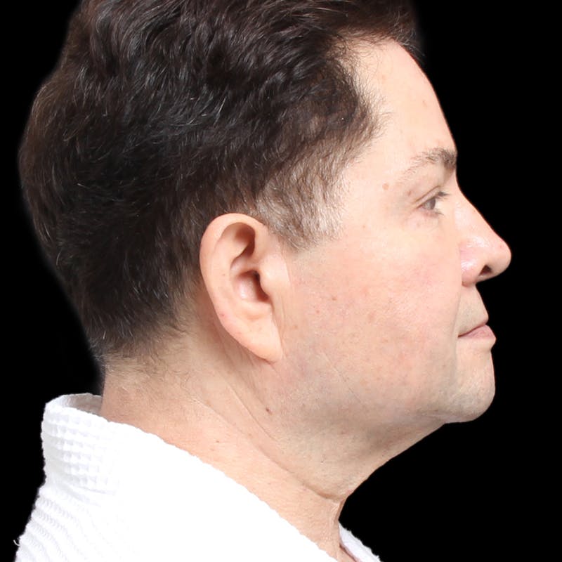 Facelift Before & After Gallery - Patient 524716 - Image 1