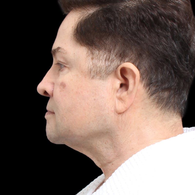 Facelift Before & After Gallery - Patient 524716 - Image 9