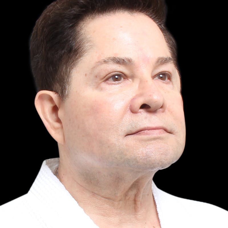 Facelift Before & After Gallery - Patient 524716 - Image 5