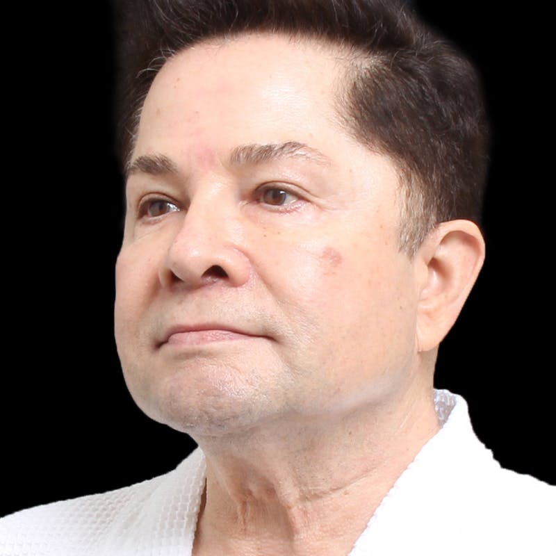Facelift Before & After Gallery - Patient 524716 - Image 7
