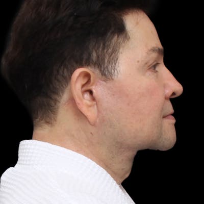Facelift Before & After Gallery - Patient 524716 - Image 2