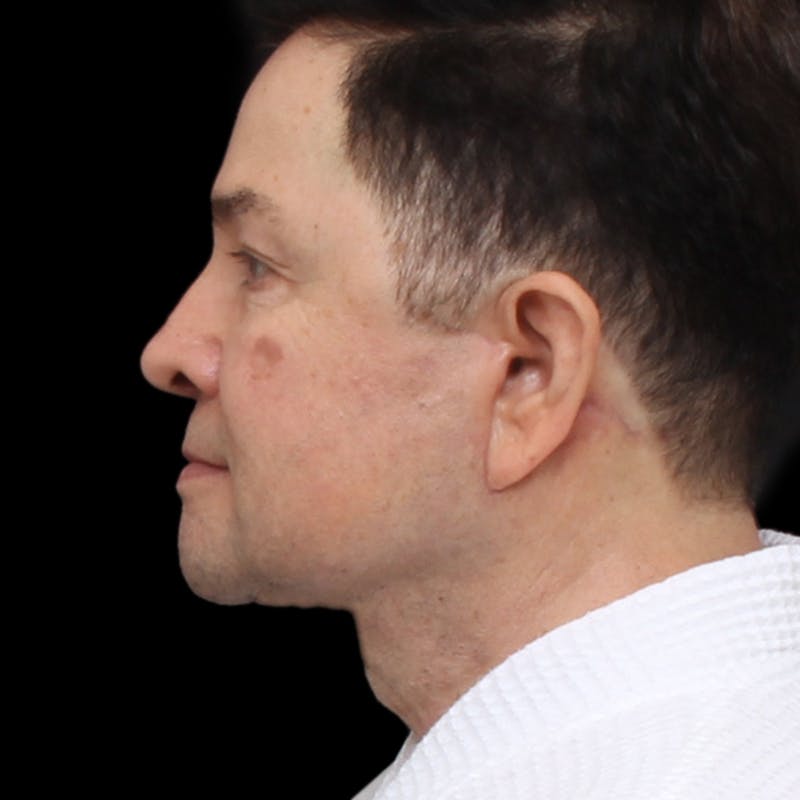 Facelift Before & After Gallery - Patient 524716 - Image 10