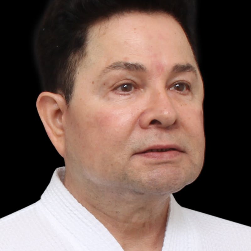 Facelift Before & After Gallery - Patient 524716 - Image 6
