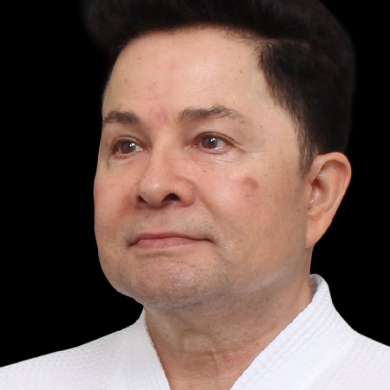 Facelift Before & After Gallery - Patient 524716 - Image 8