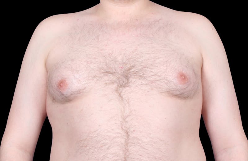 Gynecomastia Before & After Gallery - Patient 455649 - Image 1
