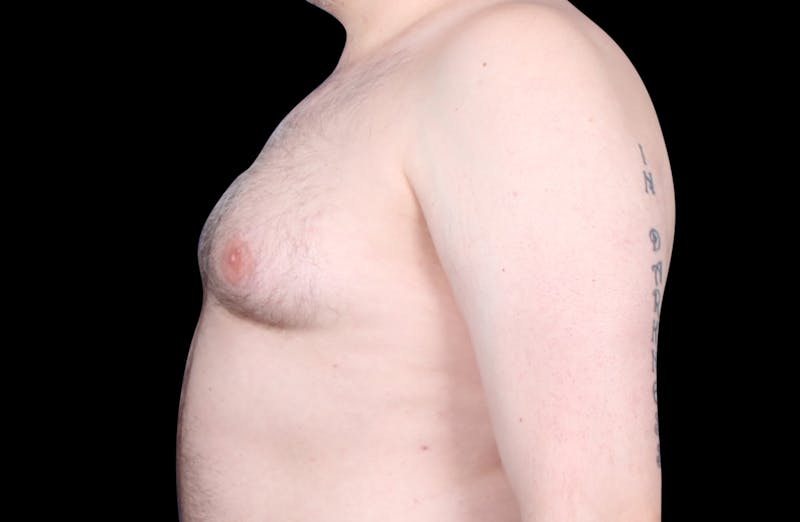 Gynecomastia Before & After Gallery - Patient 455649 - Image 9